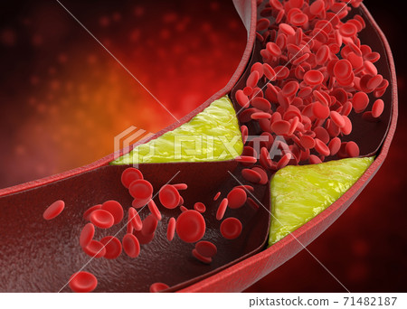 atherosclerosis with plaque in vessel 71482187