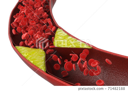 atherosclerosis with plaque in vessel atherosclerosis with plaque in vessel 71482188