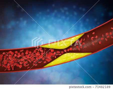 atherosclerosis with plaque in vessel atherosclerosis with plaque in vessel 71482189