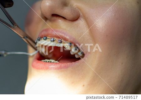 A woman at a dentist's appointment to replace arches with braces. 71489517