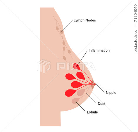 Breast disease concept Breast disease concept 71504040