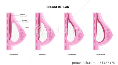 Breast Implant Concept 71527370