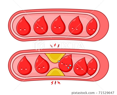 Normal and clogged blood vessels - Stock Illustration [71529647] - PIXTA