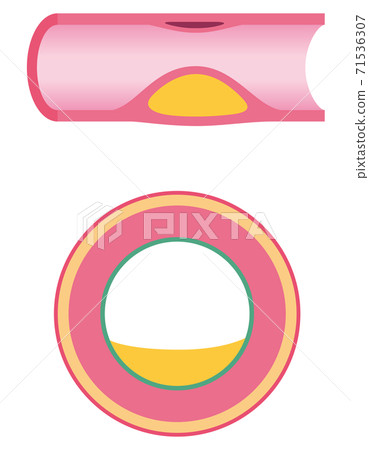 Vascular occlusion: Progress of arteriosclerosis Vascular occlusion: Progress of arteriosclerosis 71536307