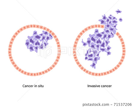 Breast disease concept 71537206