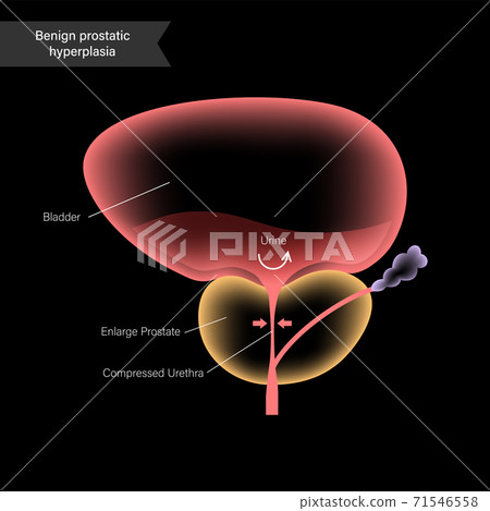 BPH info concept BPH info concept 71546558