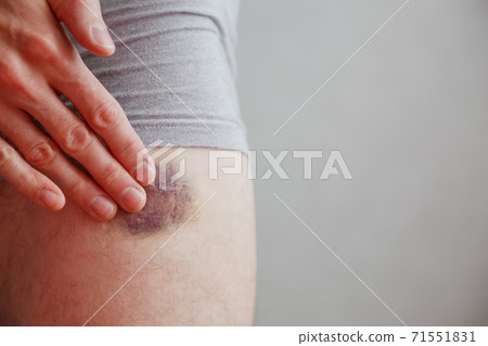 Man applies the healing gel to the bruise. Bruise on leg 71551831