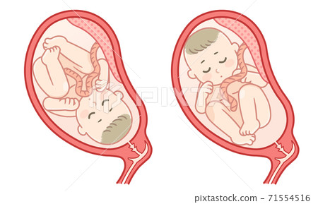 胎兒的圖示（頭部位置和倒置的孩子） 71554516