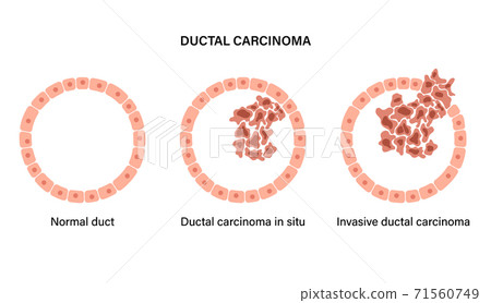 Breast disease concept 71560749