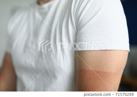 Person after taking sunbath 71570289