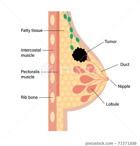 Breast disease concept 71571886