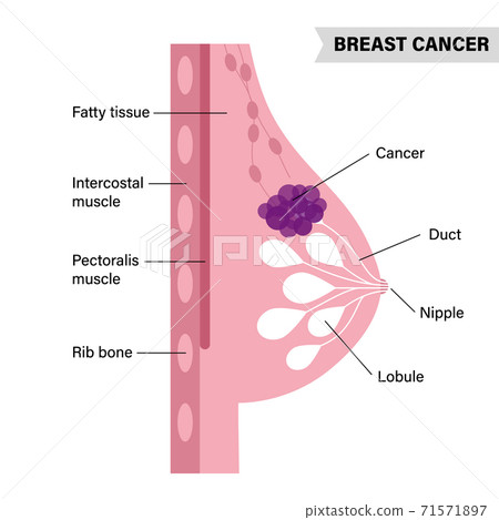 Breast disease concept 71571897