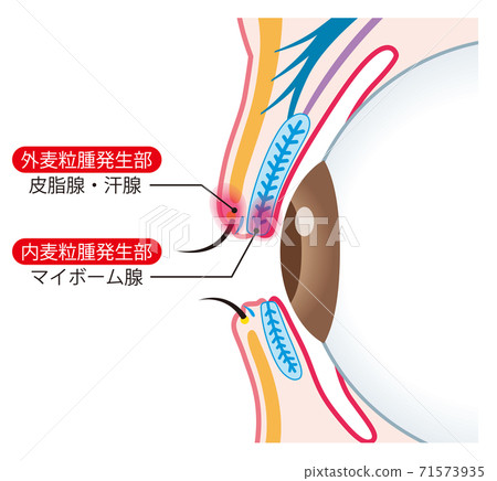 眼瞼結構小麥肉芽腫截面 眼瞼結構小麥肉芽腫截面 71573935