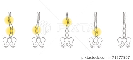 Medical posture (scoliosis) Bone upper body back 71577597