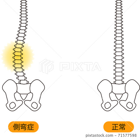 Medical posture (scoliosis) Bone upper body back 71577598