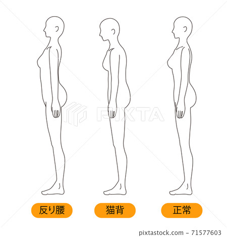Female Medical Posture Warped Waist Stoop Stock Illustration