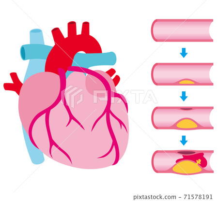 動脈硬化的血管阻塞進展 71578191
