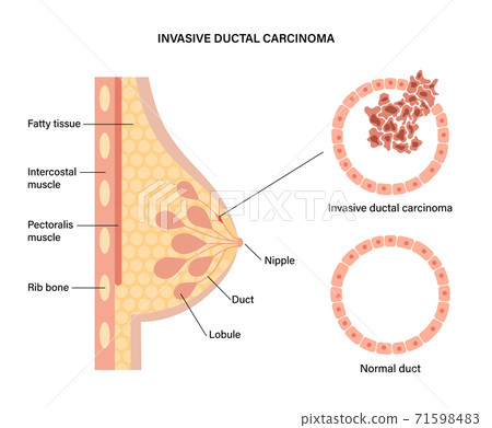 Breast disease concept 71598483