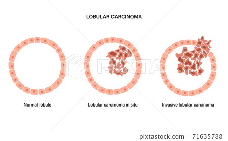 Breast disease concept 71635788