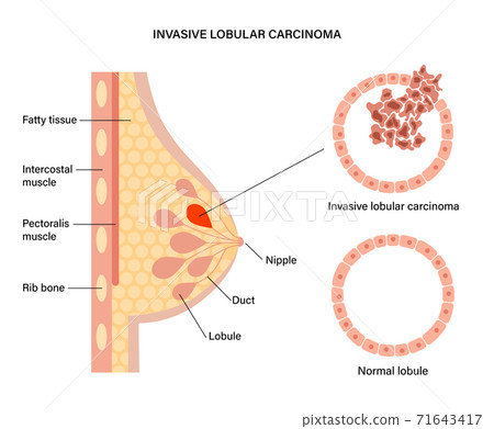 Breast disease concept 71643417