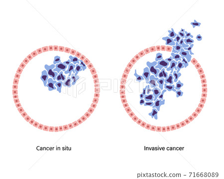 Breast disease concept 71668089