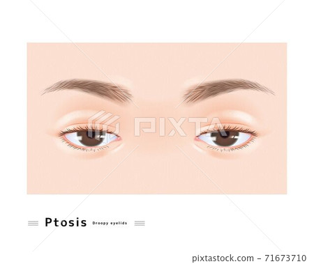 眼瞼下垂雙眼女性面部眼困眼瞼下垂眼科案例圖 71673710