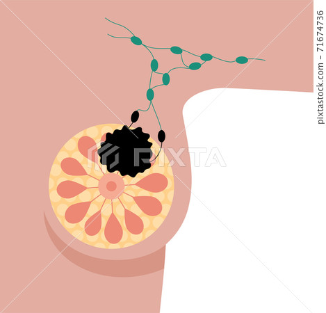 Breast disease concept Breast disease concept 71674736