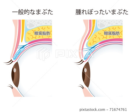 眼瞼腫脹眼瞼結構 眼瞼腫脹眼瞼結構 71674761