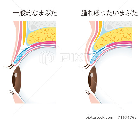 眼瞼腫脹眼瞼結構 71674763
