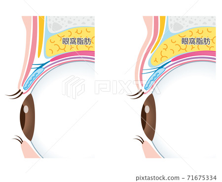 Swollen eyelid structure 71675334