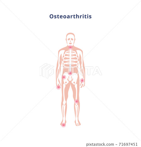 Diagram of body with joint damage by osteoarthritis, flat vector illustration. 71697451
