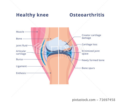 Healthy joint and damaged with osteoarthritis, flat vector illustration. 71697458