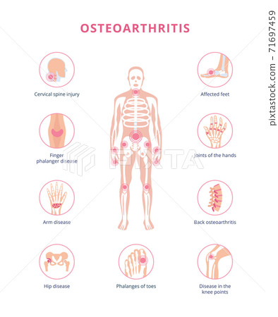 Medical scheme of osteoarthritis joint damage, flat vector illustration isolated. 71697459