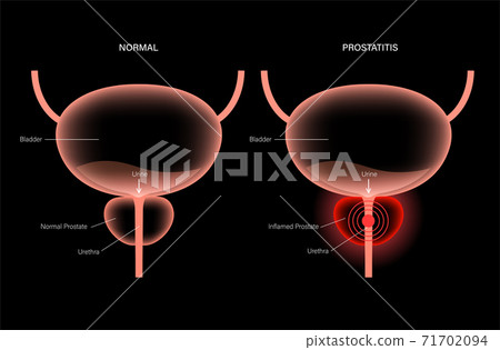 Prostatitis inflammation problem 71702094