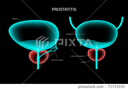 Prostatitis inflammation problem Prostatitis inflammation problem 71733591
