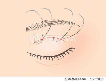 雙重手術的圖示（埋葬方法，兩點固定） 71737838