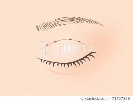 Illustration of double surgery (burial method, two-point fastening) 71737839