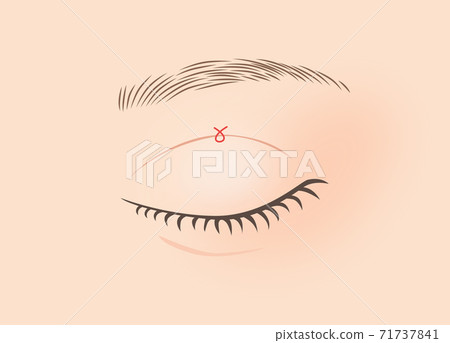 Illustration of double surgery (burial method, 1 point retention) Illustration of double surgery (burial method, 1 point retention) 71737841