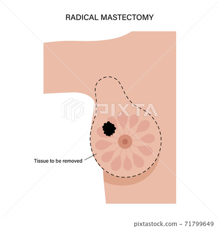 Breast disease concept 71799649