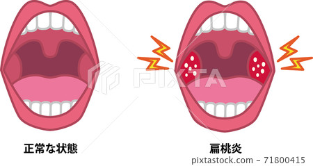 Illustration of tonsillitis 71800415