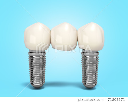 Tooth human bridge implant Dental concept Human teeth or dentures  multitooth 3d render on blue gradient 71803271