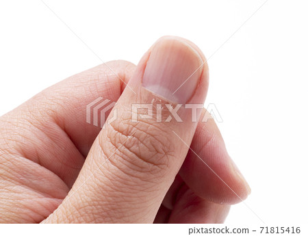 Finger hangnail 71815416