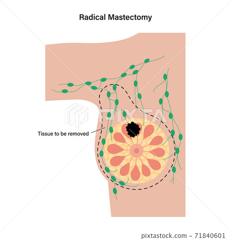 Breast disease concept Breast disease concept 71840601