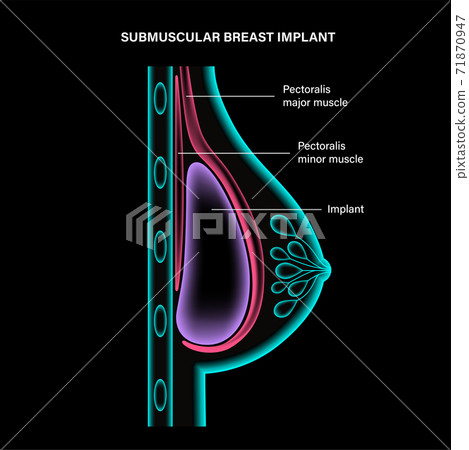 Breast Implant Concept 71870947
