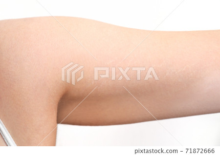 Striae atrophic line Striae atrophic line 71872666