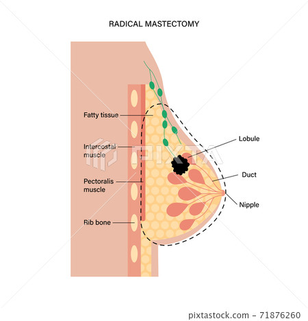 Breast disease concept Breast disease concept 71876260