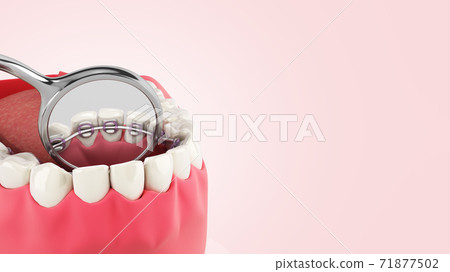 Lingual braces system on a demonstration denture 3d close up on color gradient 71877502