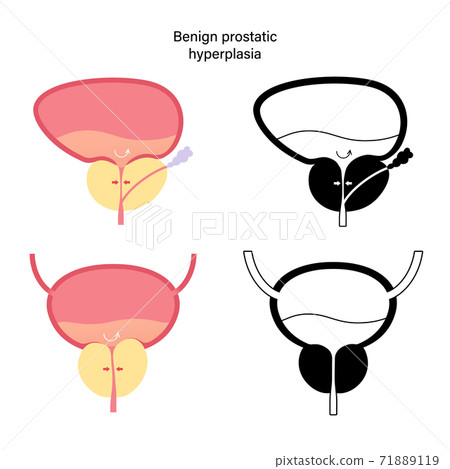 BPH info concept BPH info concept 71889119