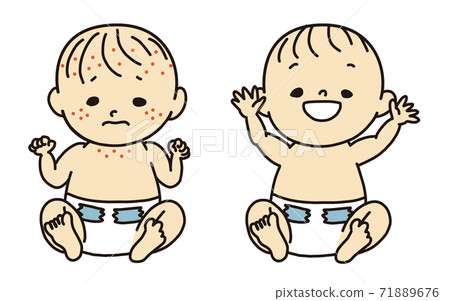 Baby eczema onset completely cured - Stock Illustration [71889676] - PIXTA