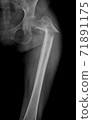 X-ray image of the right femur fracture in elderly women is the most common position in a fall accident. 71891175